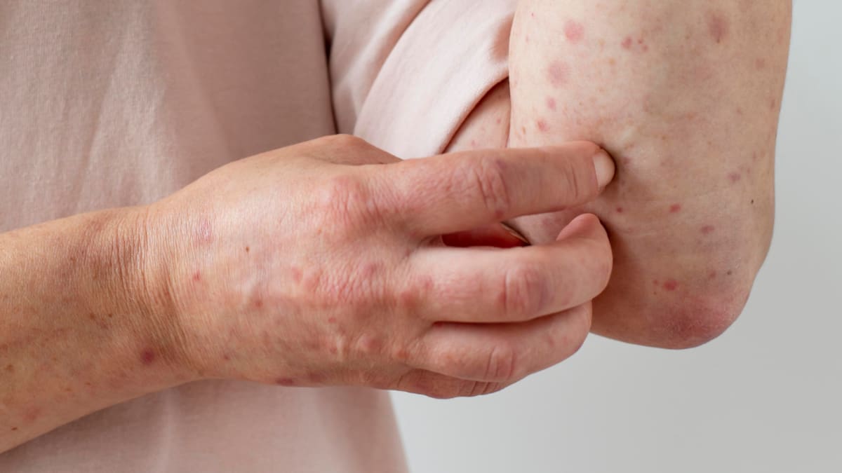 Espírito Santo confirma primeiro caso de Mpox em 2026