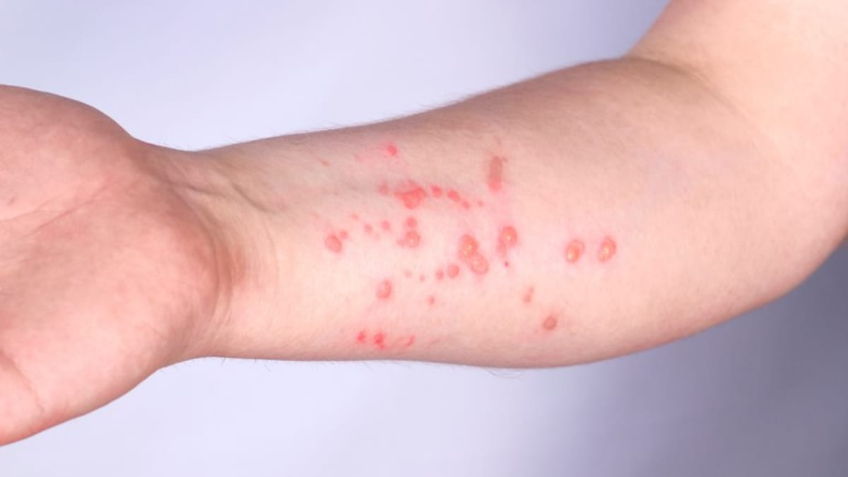 Brasil registra 90 casos de mpox em 2026 com quadros leves ou moderados