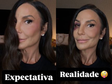 Ivete Sangalo mostra hematoma no rosto após queda causada por desidratação