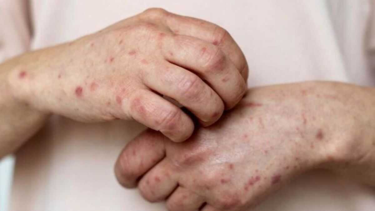 Brasil confirma novos casos de mpox e alerta para grupos de alto risco