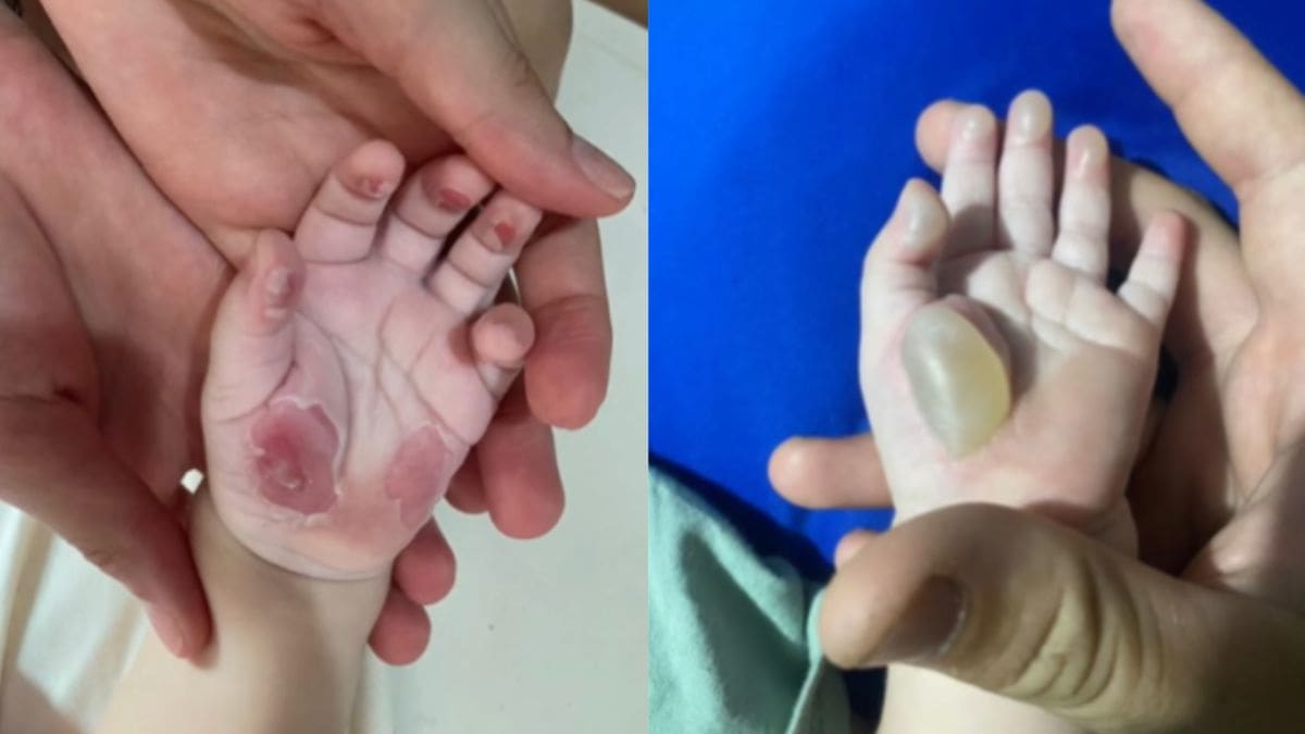 Bebê que sofreu queimaduras nas mãos em creche de SC recebe alta