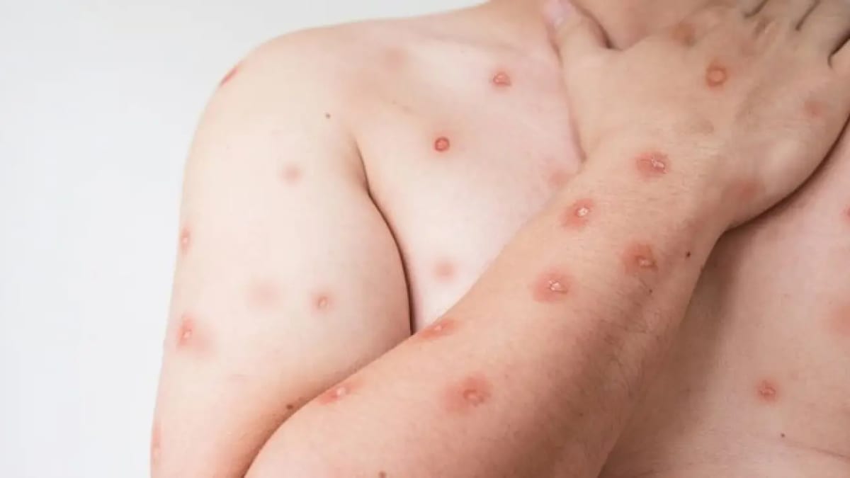 Goiás investiga 11 casos suspeitos de Mpox em 2026