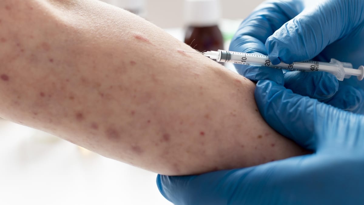 Minas Gerais registra 12 casos confirmados de mpox em 2026