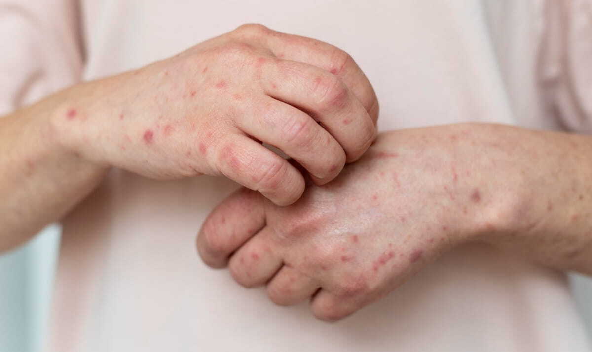 Sarampo volta a assustar nas Américas e Brasil confirma primeiro caso em São Paulo em 2026