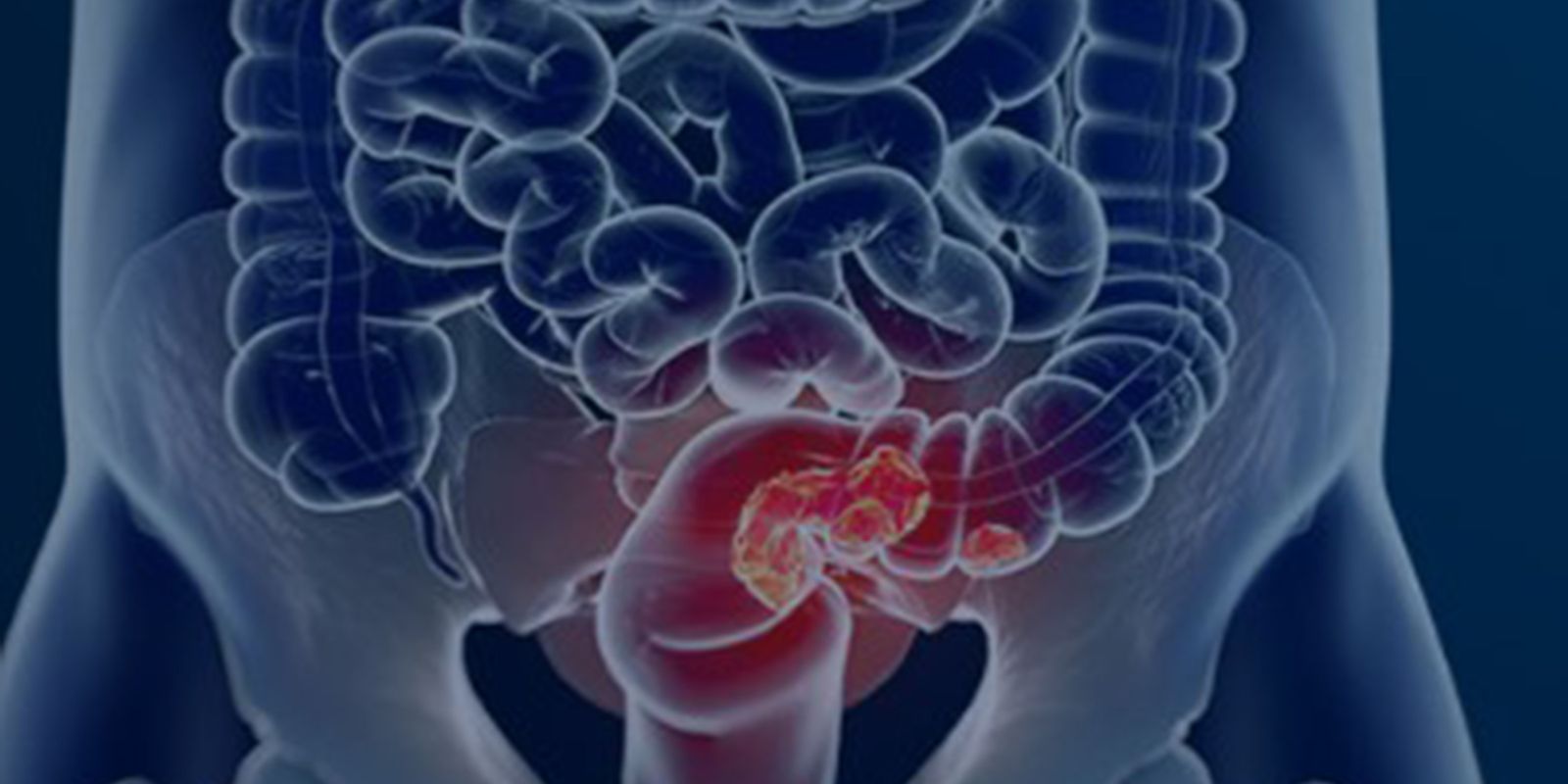 Novo programa pode ampliar rastreamento do câncer colorretal no SUS