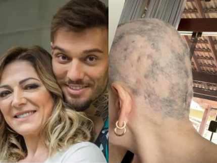 Mãe de Lucas Lucco fala sobre alopecia e mostra falhas no cabelo
