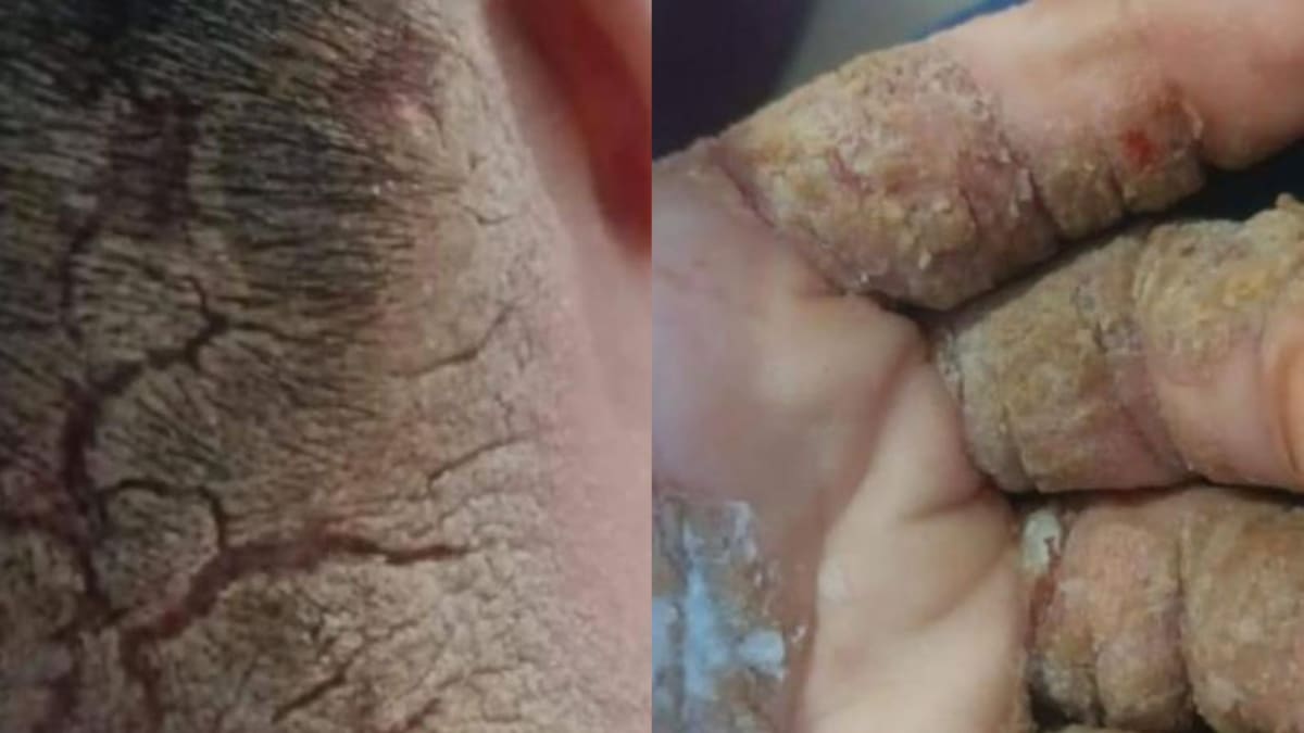 Família de adolescente com síndrome de Down em Canoinhas pede ajuda para tratamento de doença de pele rara