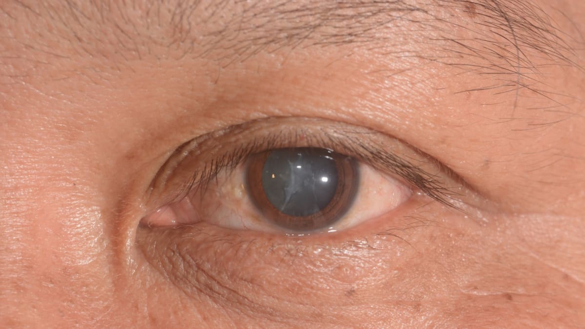 Catarata lidera casos de cegueira e reforça importância do diagnóstico precoce