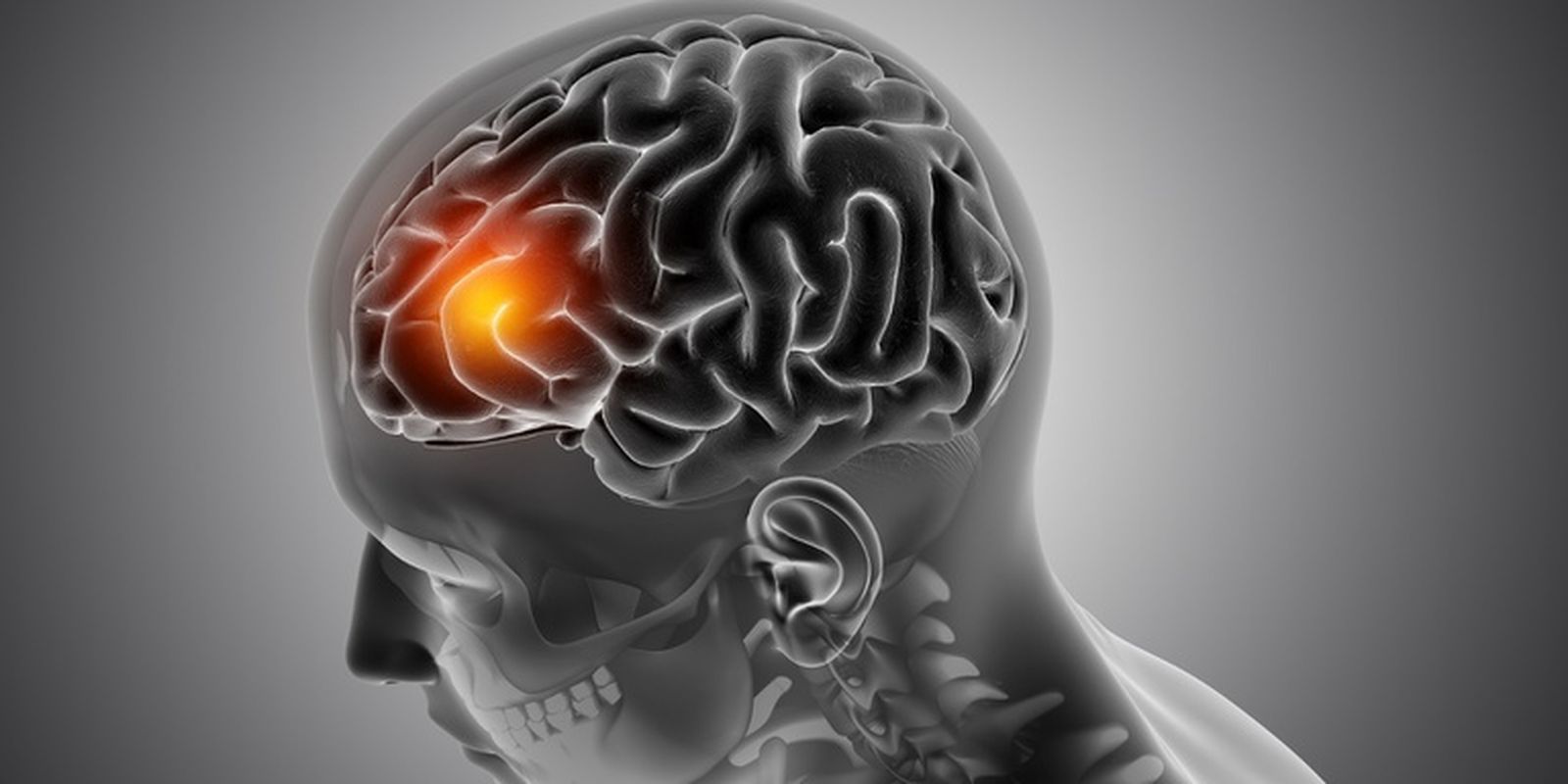 Neurologista comenta aumento de casos de AVC em jovens