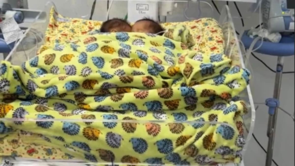 Bebês siameses que nasceram unidos pelo abdômen morrem em Goiânia