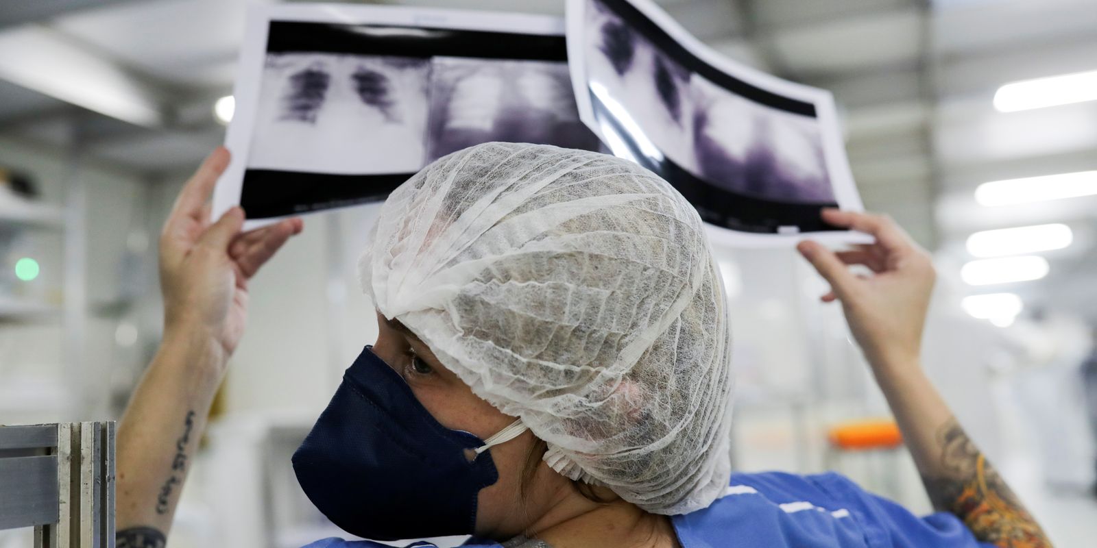 Diagnóstico tardio do câncer de pulmão no Brasil